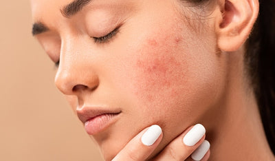 Acne-prone Skin